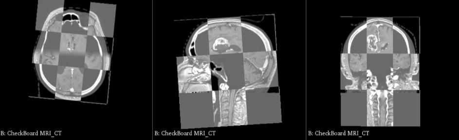 Aligning MRI and CT datasets