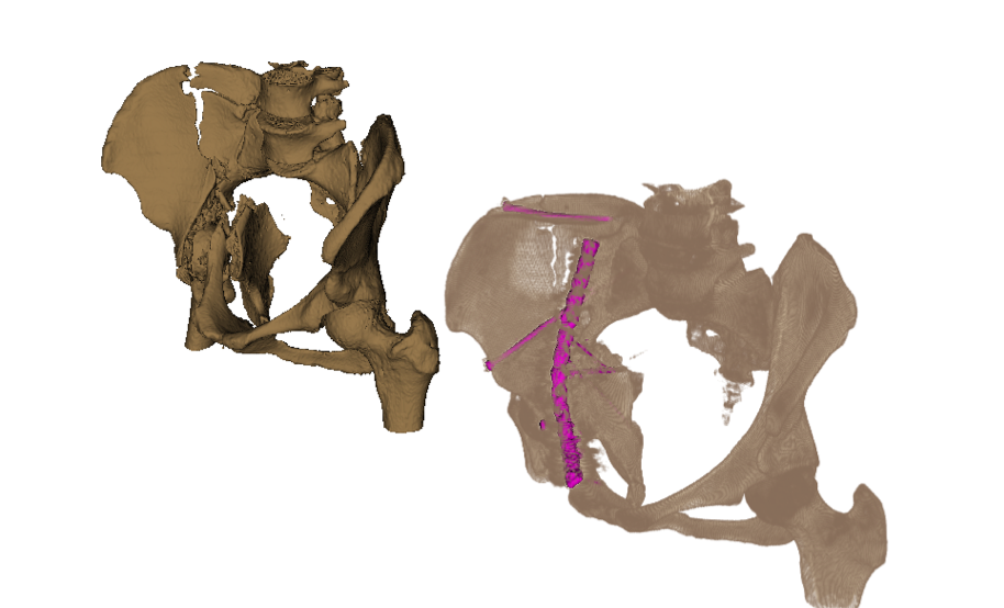 Comparison of pre- and post-surgery pelvis
