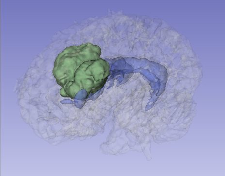 iDVR of tumour, ventricles, and brain, with adjusted opacities