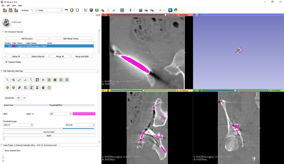 iDVR of pins in pelvis after surgery