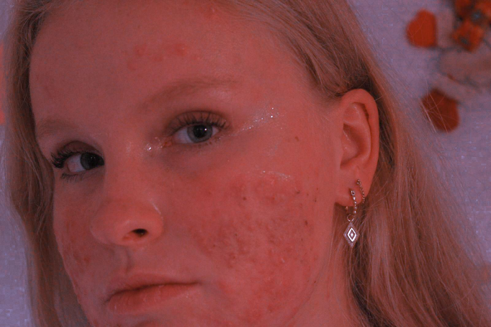 Romantisicing having acne, 2021