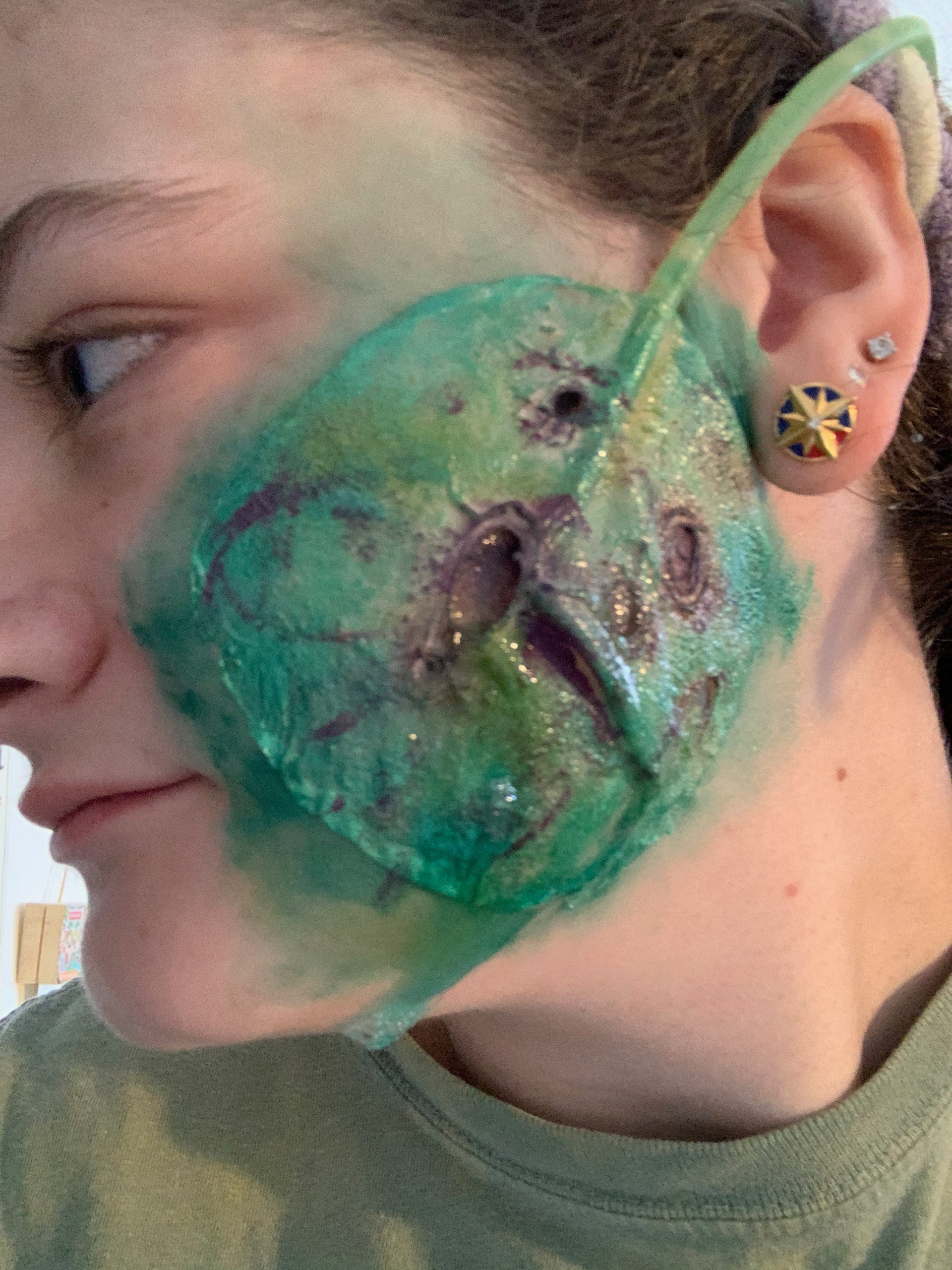 Bleeding Prosthetic Application (tube exposed)