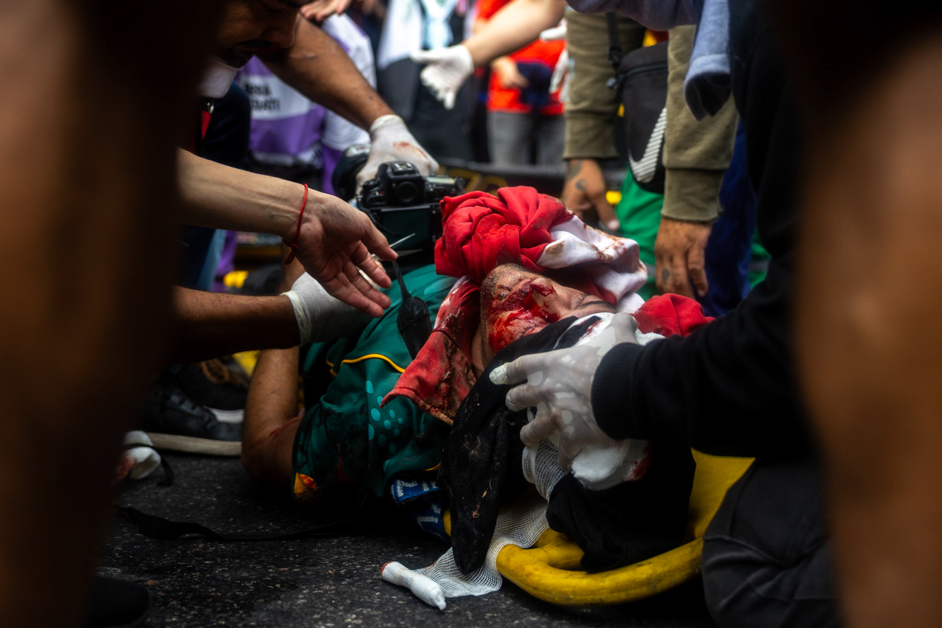 Photojournalist Pablo Grillo receives medical attention after Argentine security forces fired a tear gas canister that struck him in the head while he was covering a protest | Buenos Aires, 2025.