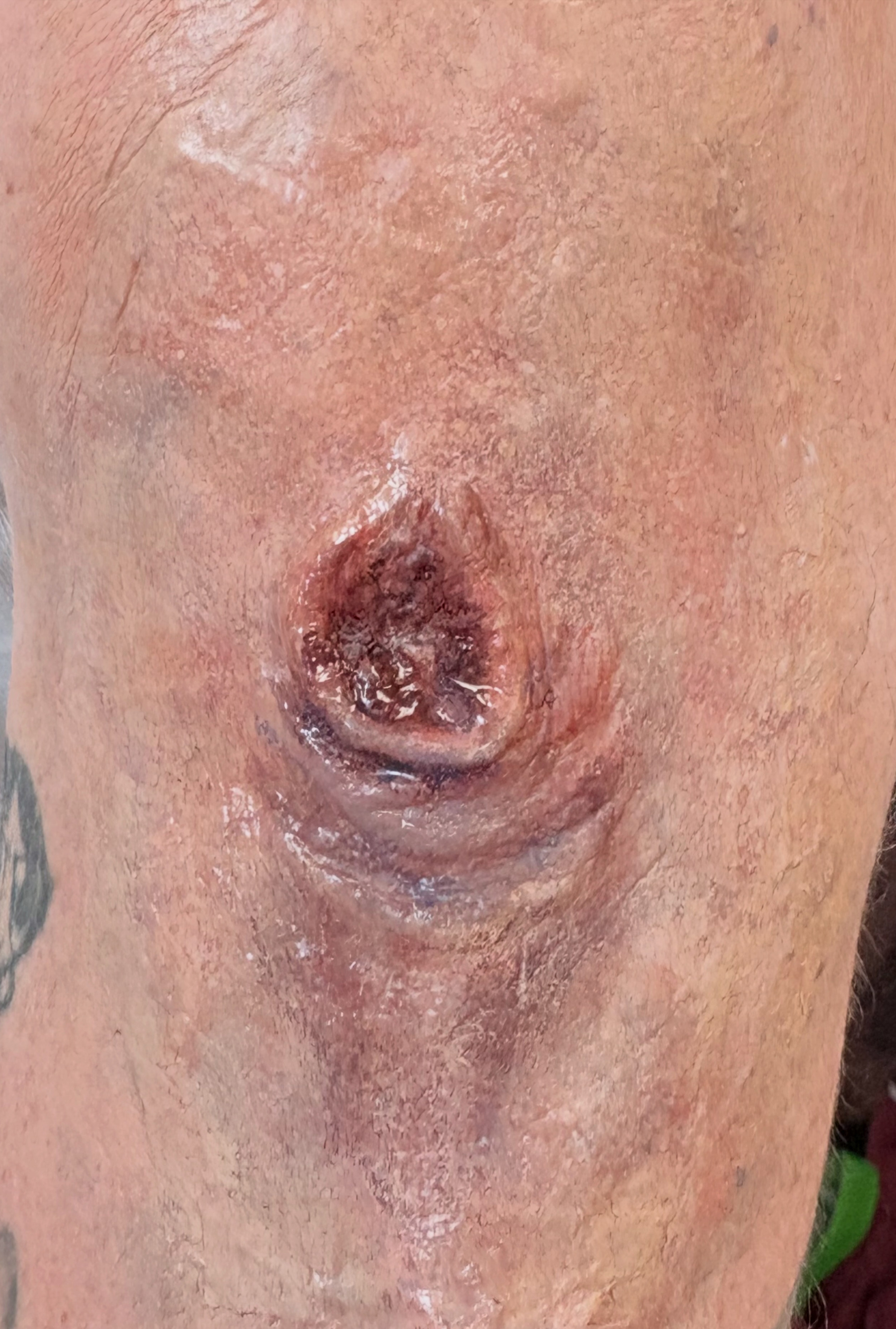 Bolt Wound (Video below)
