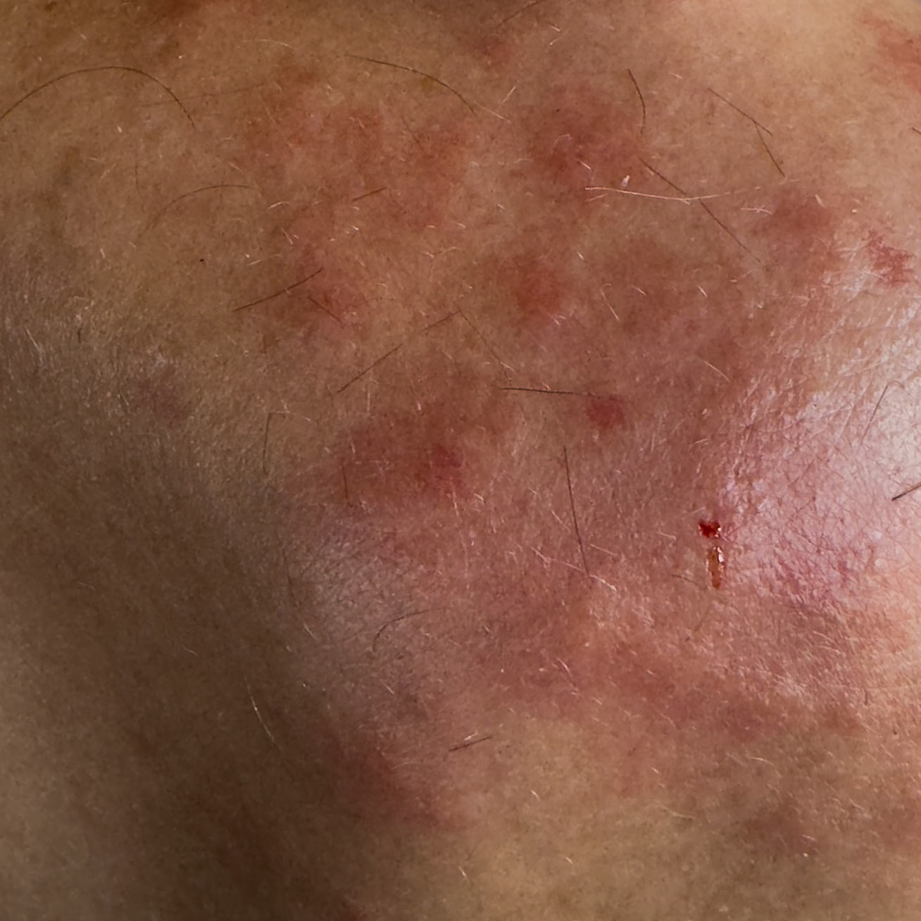 after the hike: one of my shoulders after the swarm of mosquitoes that ambushed us in Bathonea south