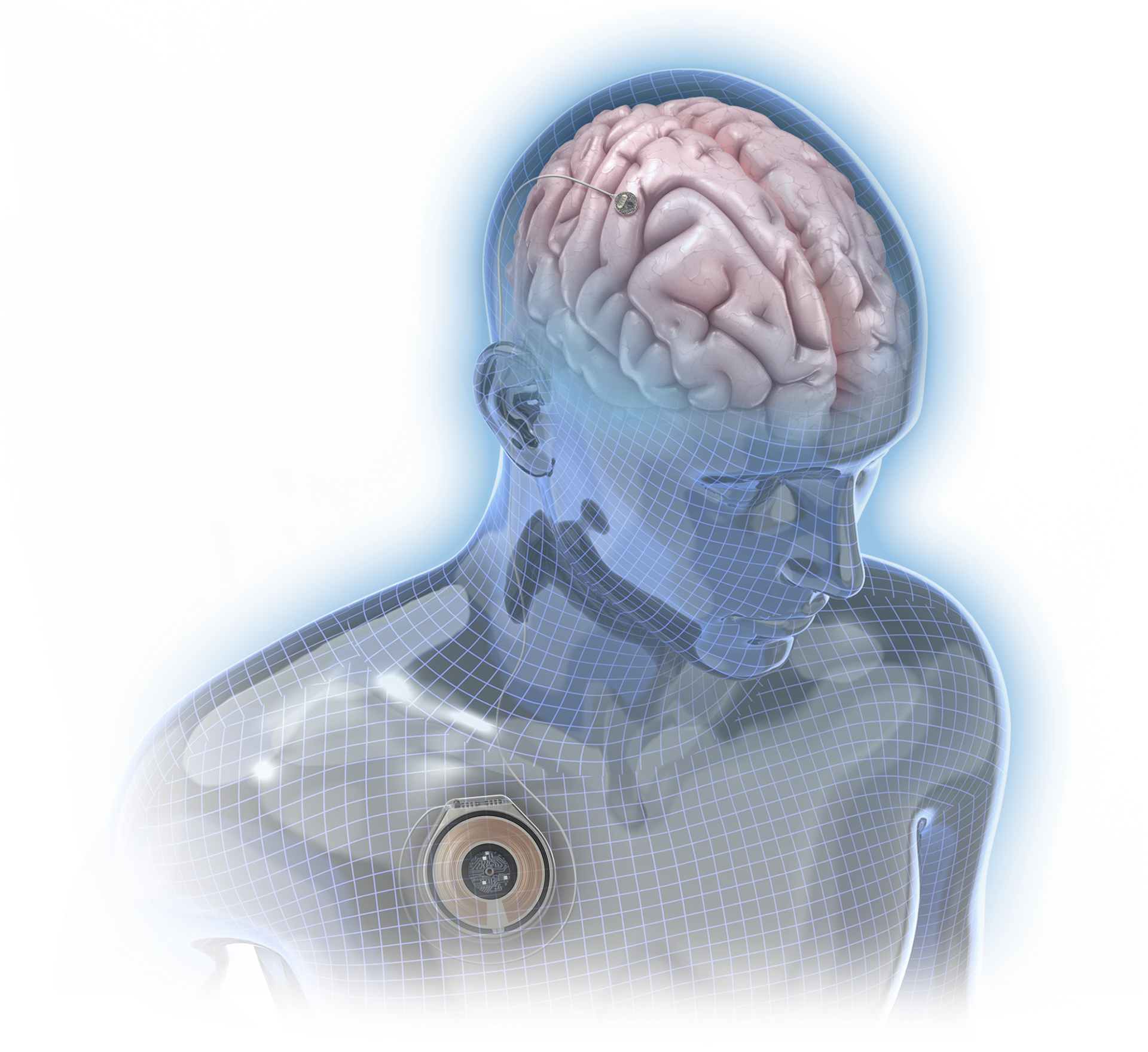 Medical Illustration of brain implant by medical illustrator Wayne Heim..