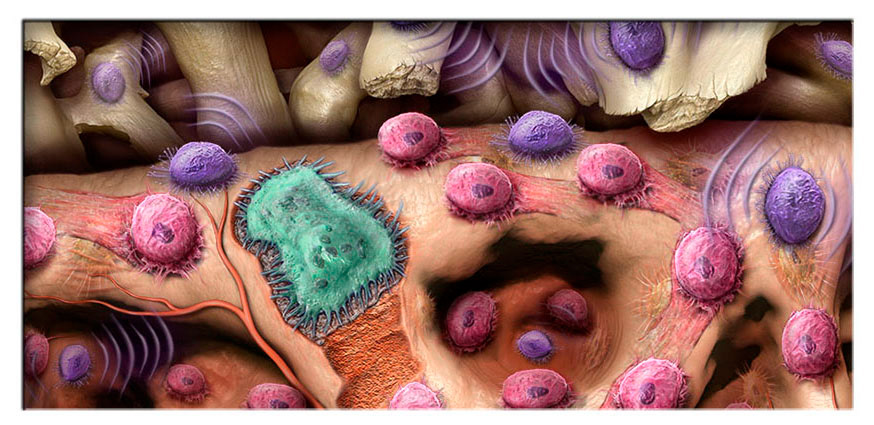 Medical illustration of bone cells remodeling bone graph. © Wayne Heim