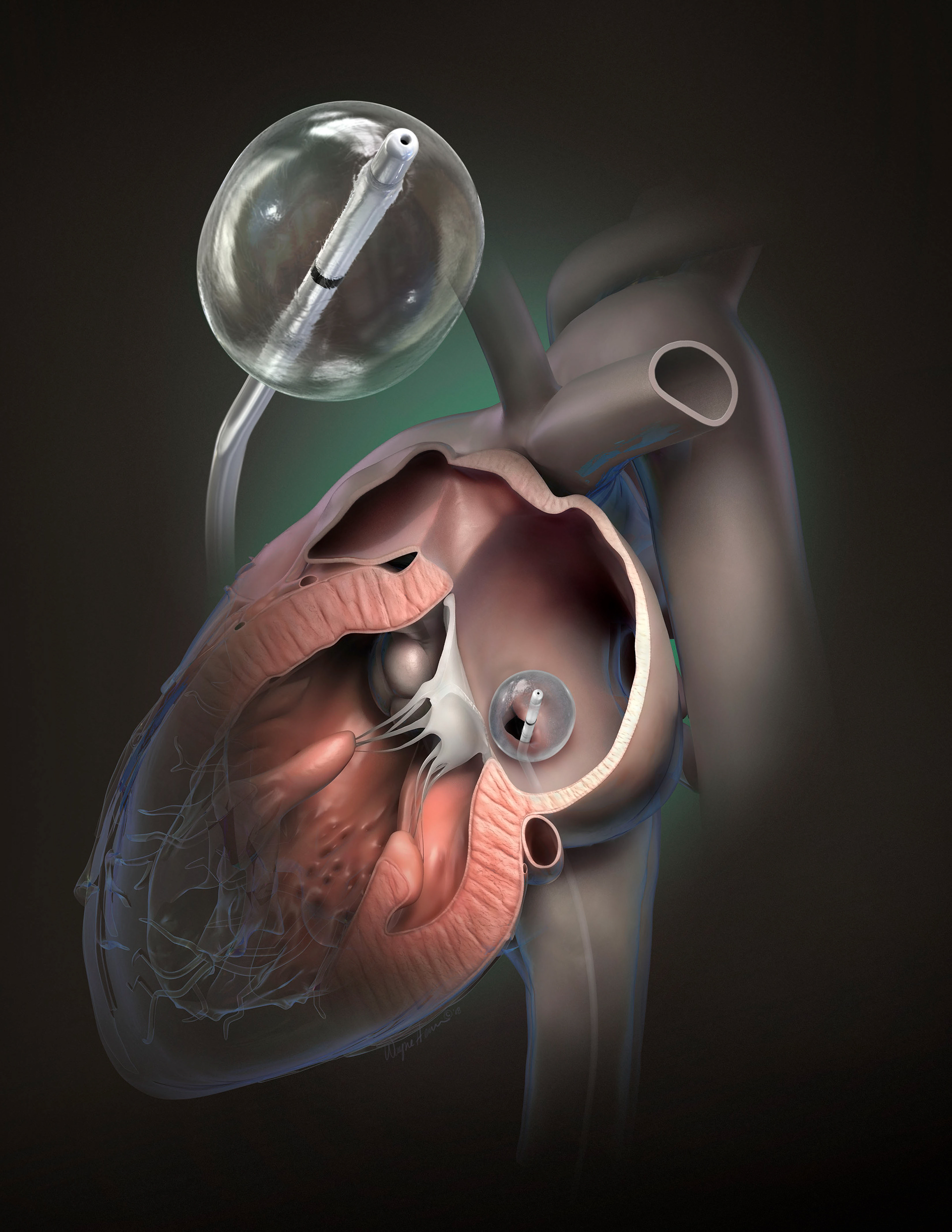 Advertising medical illustration of heart procedure