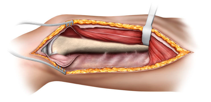 Medical illustration of surgical exposure of femur.