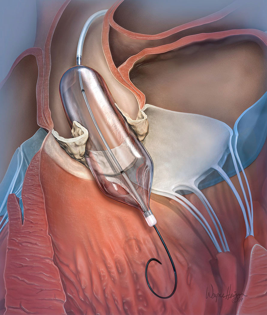 Marketing illustration of balloon stent used to break open calcified valves in heart. BBraun.