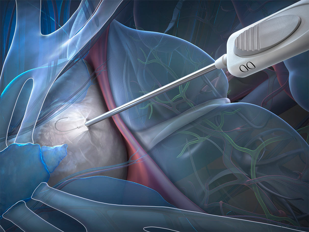 Percutaneous under the rib pericardial retractor