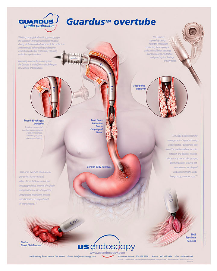 Marketing illustration of protective gastric tube.