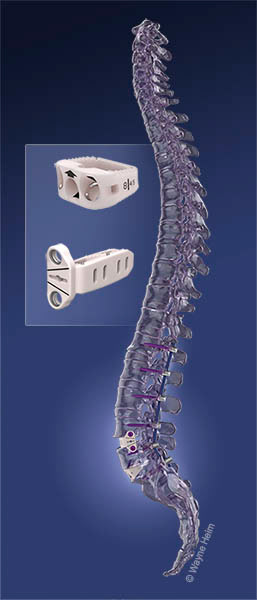 Medical device illustration