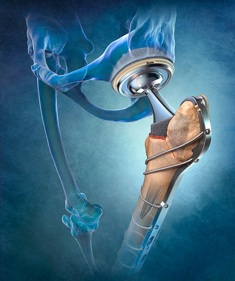 Hip Fracture Repair