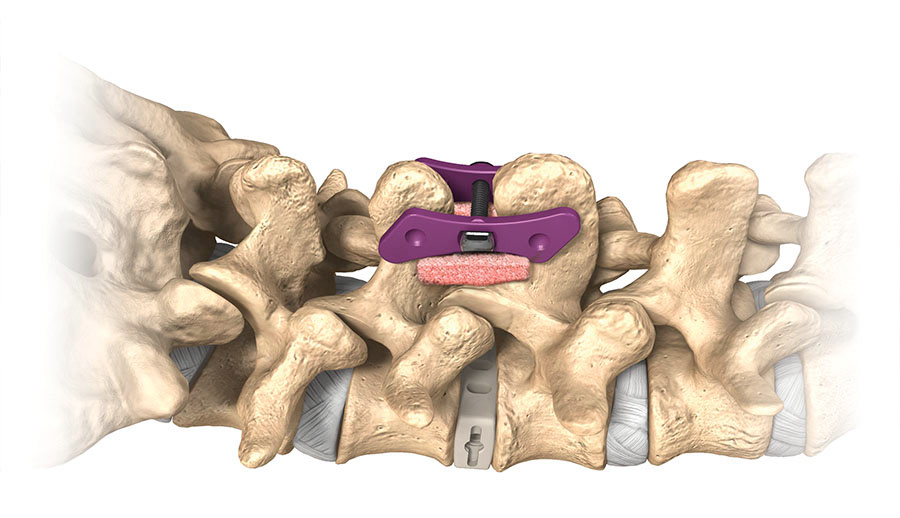 Orthopedic medical illustration of spinal fusion. © W. Heim