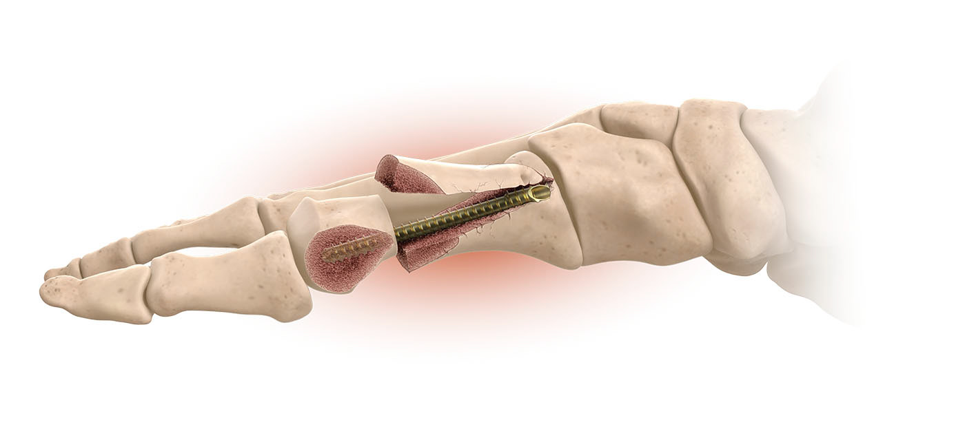 Medical illustration of bunion surgery of the foot.
