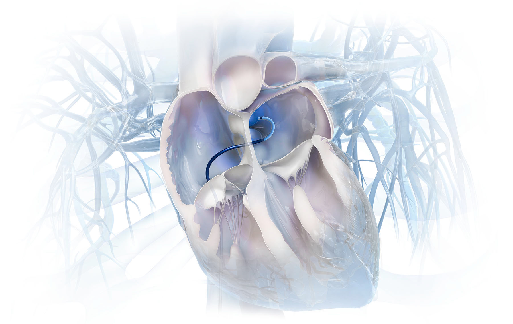 Medical advertising illustration showcasing a heart with a stent.