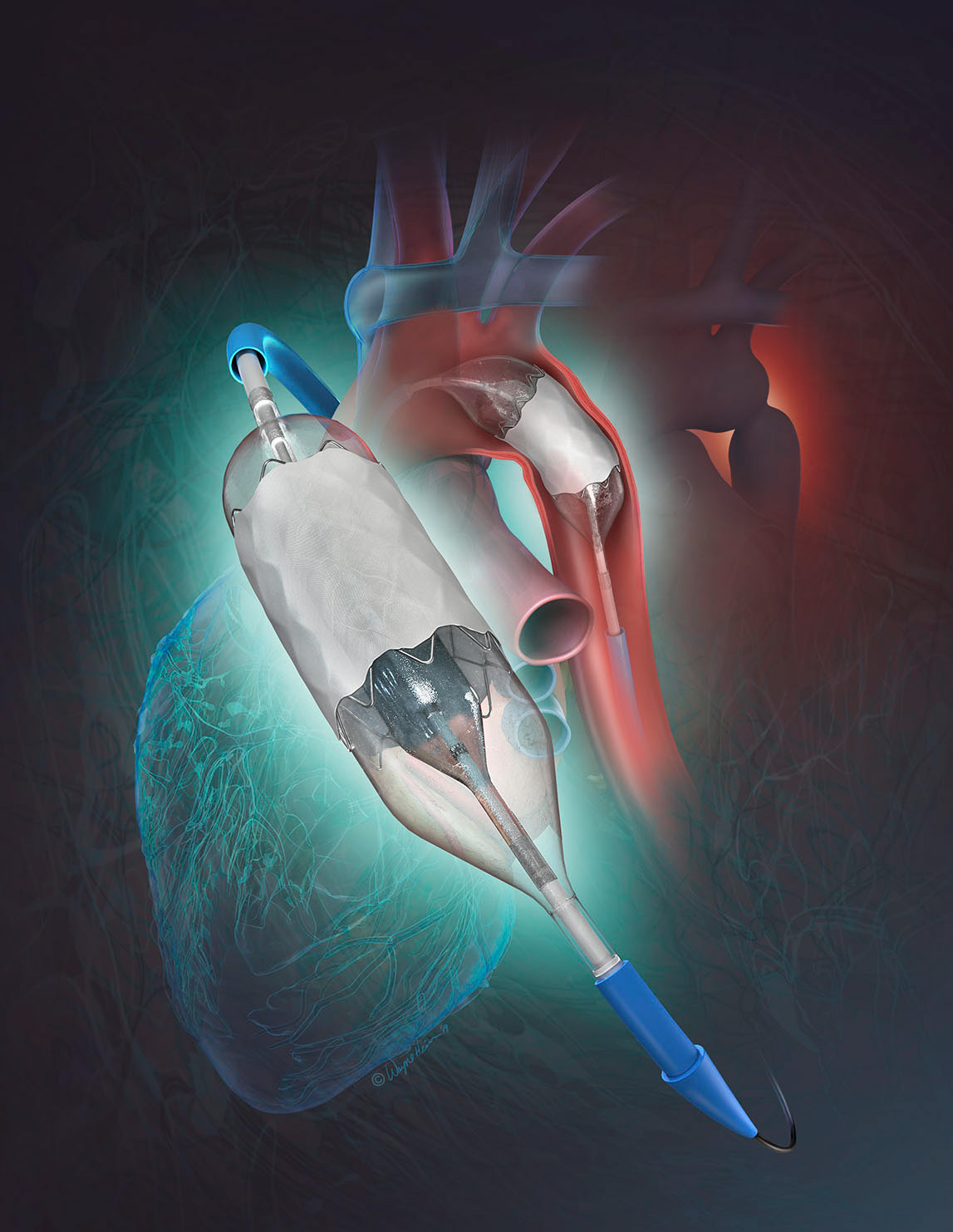 Medical advertising illustration of double balloon stent in heart.