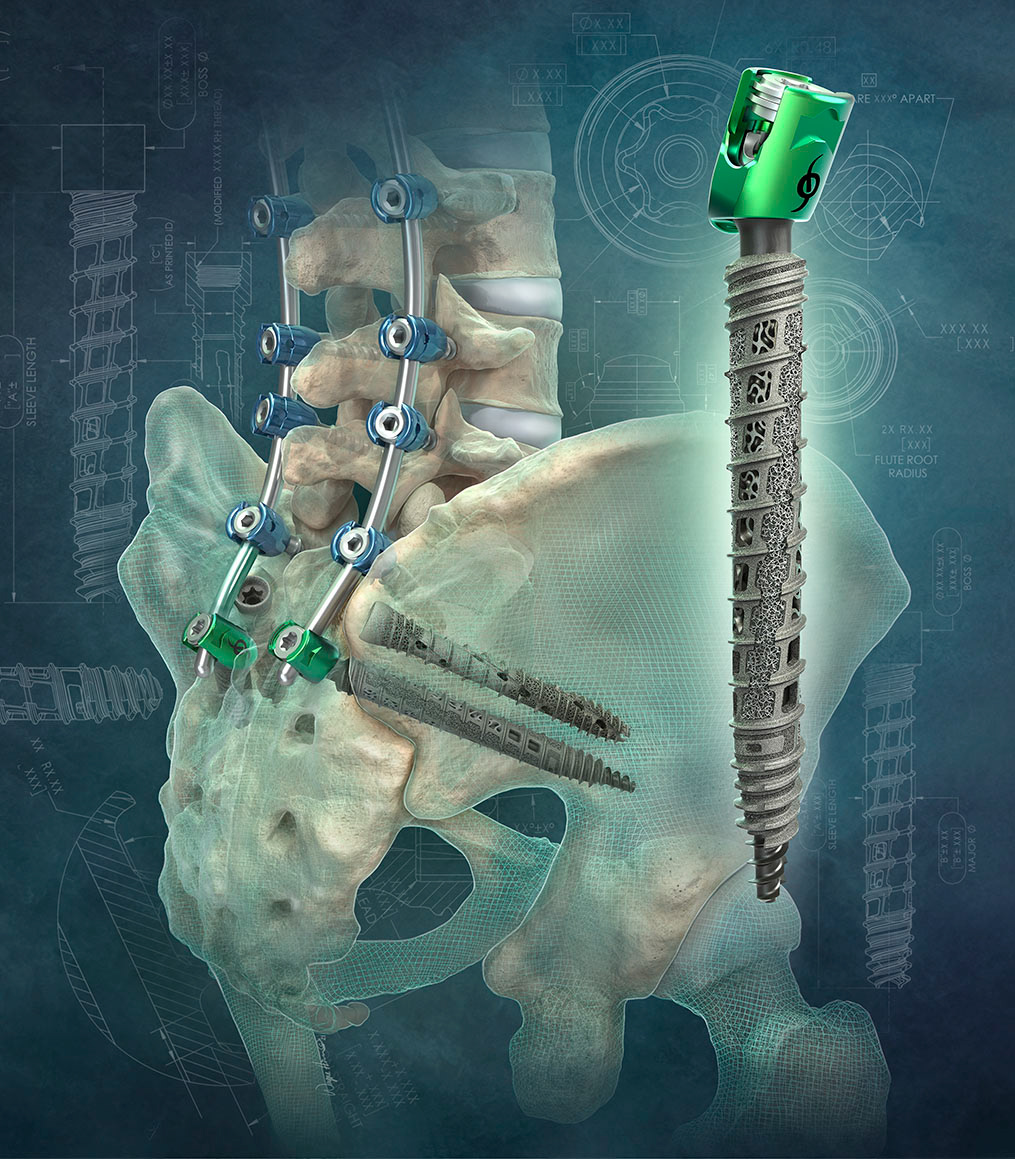 Award winning medical illustration of orthopedic surgical procedure used for advertising and marketing.