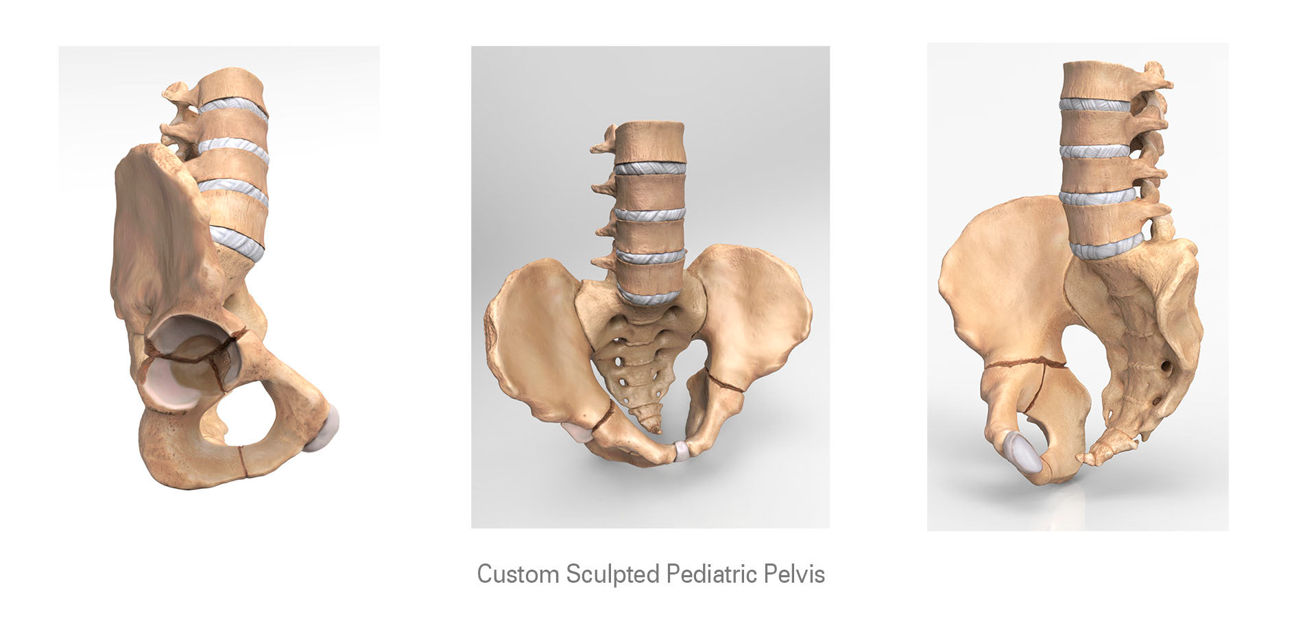 Custom 3D model of pediatric pelvis