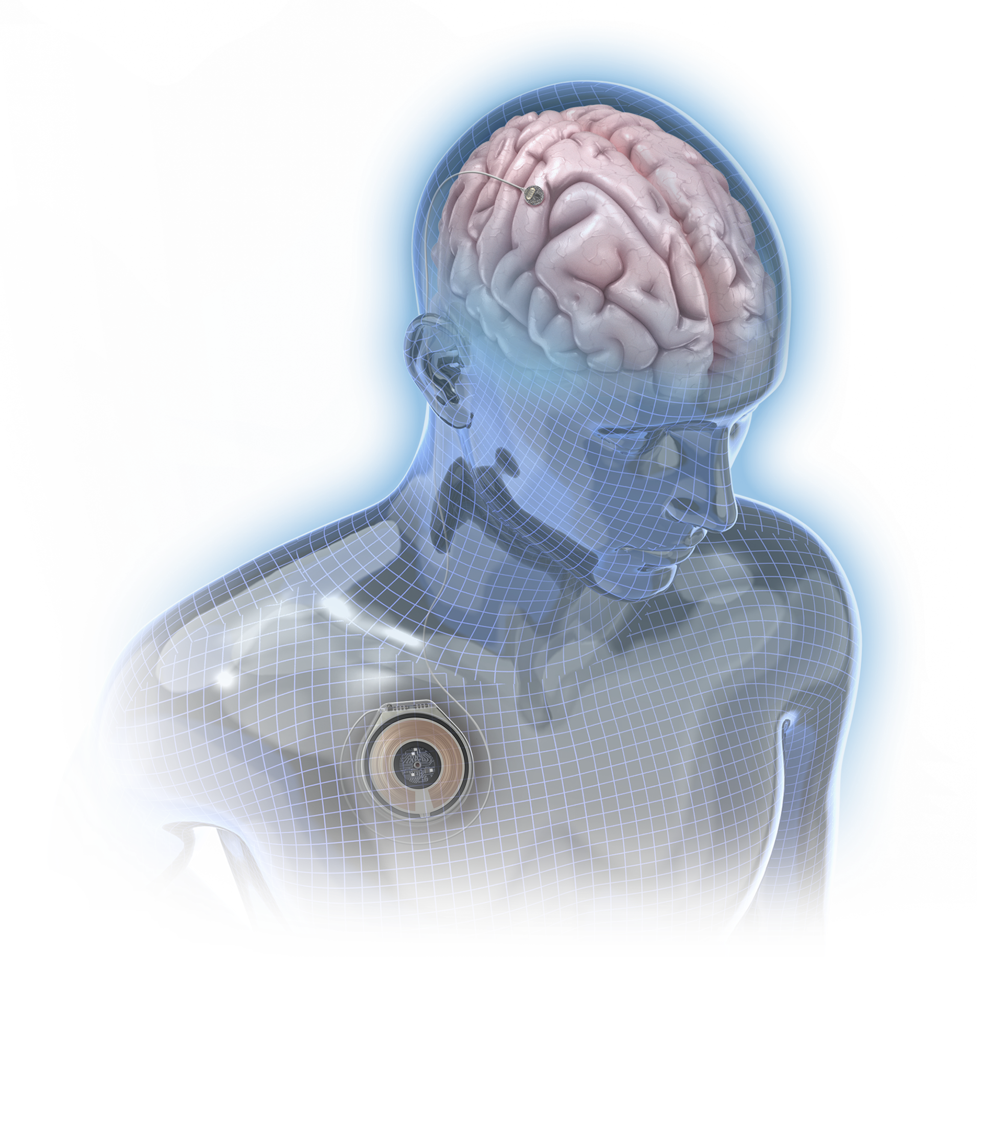 Paradromics Implantable Cortical Module