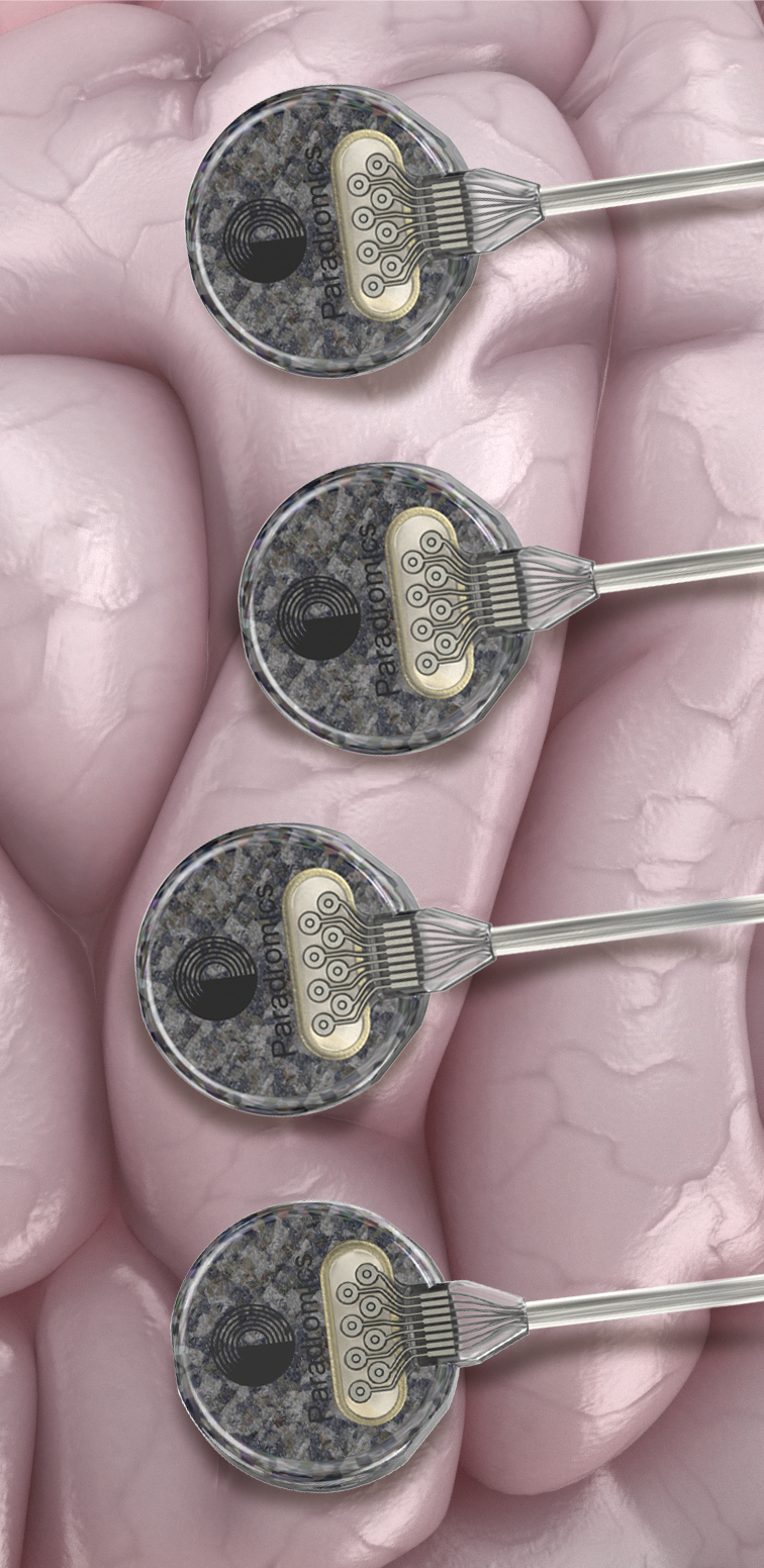 Medical illustration of neuro-brain stimulators implanted in the brain.