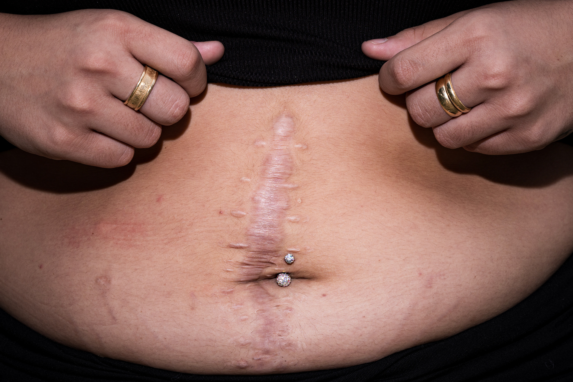 Mia Dominguez shows the surgery scar as a result of a bullet wound she suffered in the abdomen. Dominguez, along with her cousin Zechariah Trevino, were shot outside of a Whataburger restaurant in January 2023 stemming from a social media conflict. Trevino was killed and Dominguez spent days in the hospital and was left with a scar across her abdomen.
