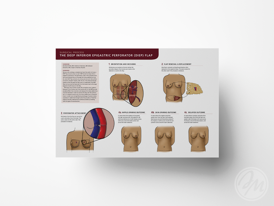 DIEP Flap Surgical Process / Illustrator, Photoshop & InDesign / 2019
