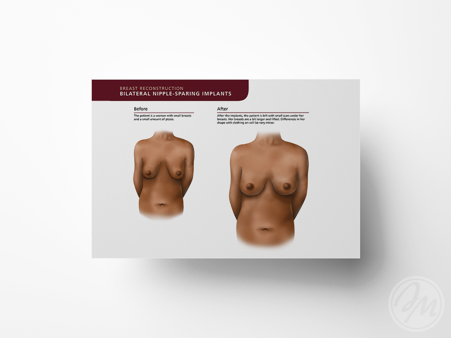 Before & After Bilateral Implants / Photoshop and InDesign / 2019