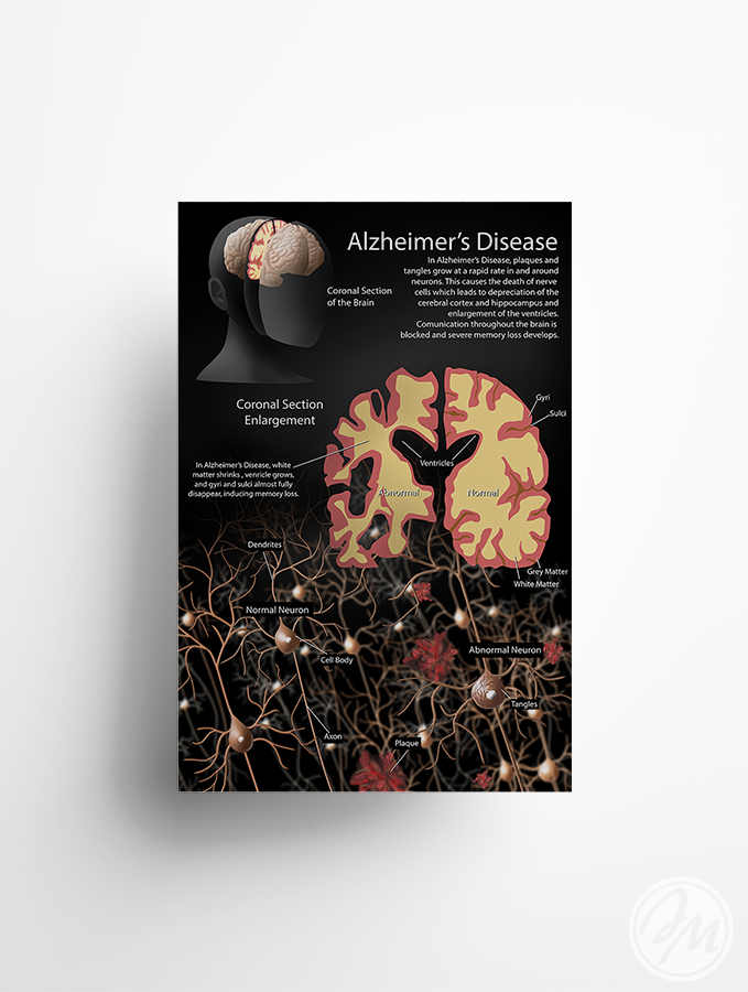 Alzheimer's disease / Photoshop / 2018