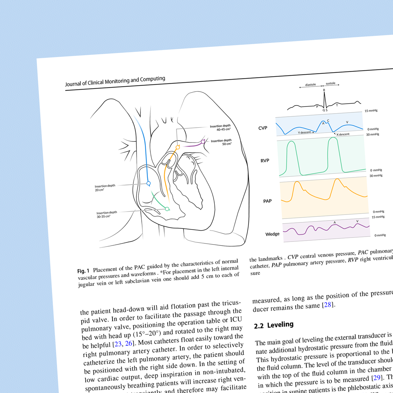 Placement of the Pulmonary artery catheter guided by the characteristics of normal vascular pressures and waveforms.