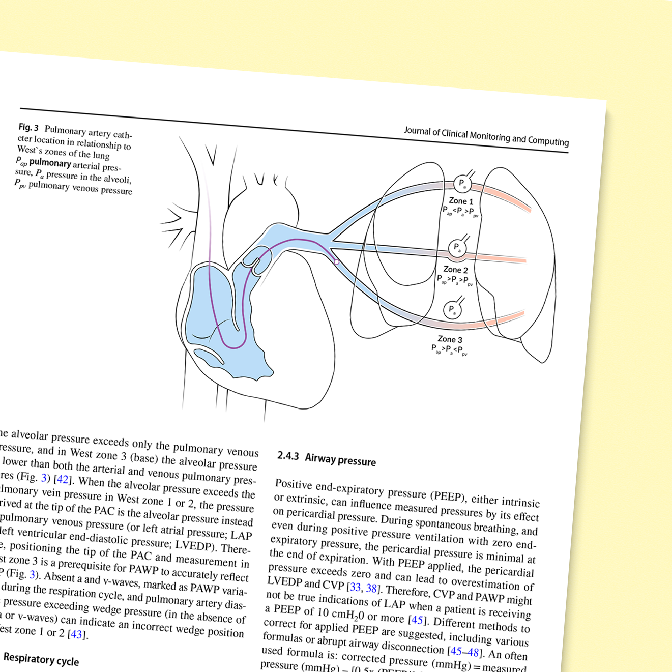 Pulmonary artery catheter location in relationship to West's zones of the lung pulmonary-arterial pressure, pressure in the alveoli and pulmonary venous pressure.