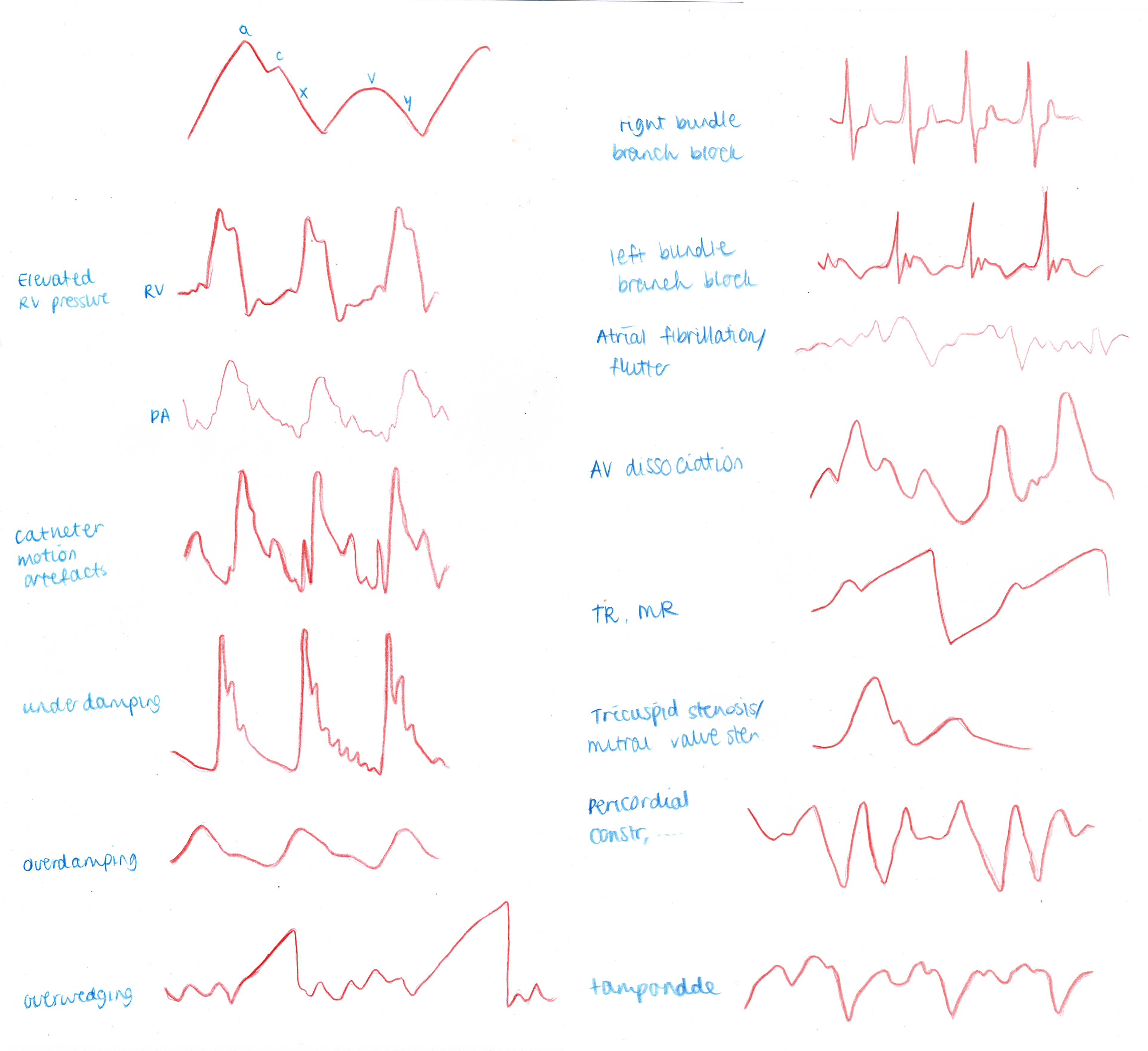 pulmonary artery catheter waveforms