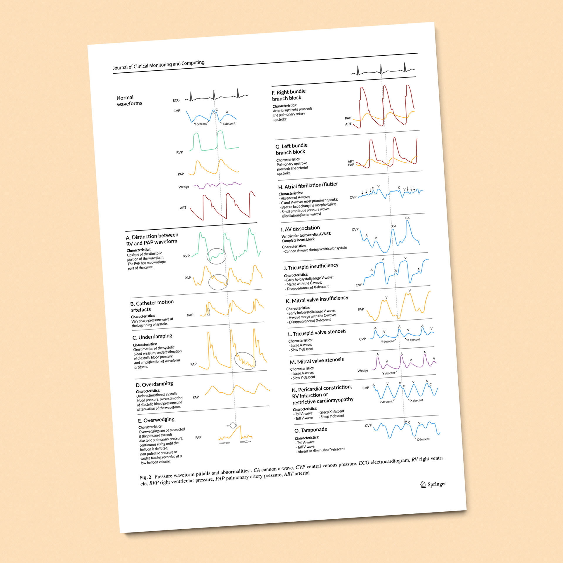 Pressure waveform pitfalls and abnormalities.