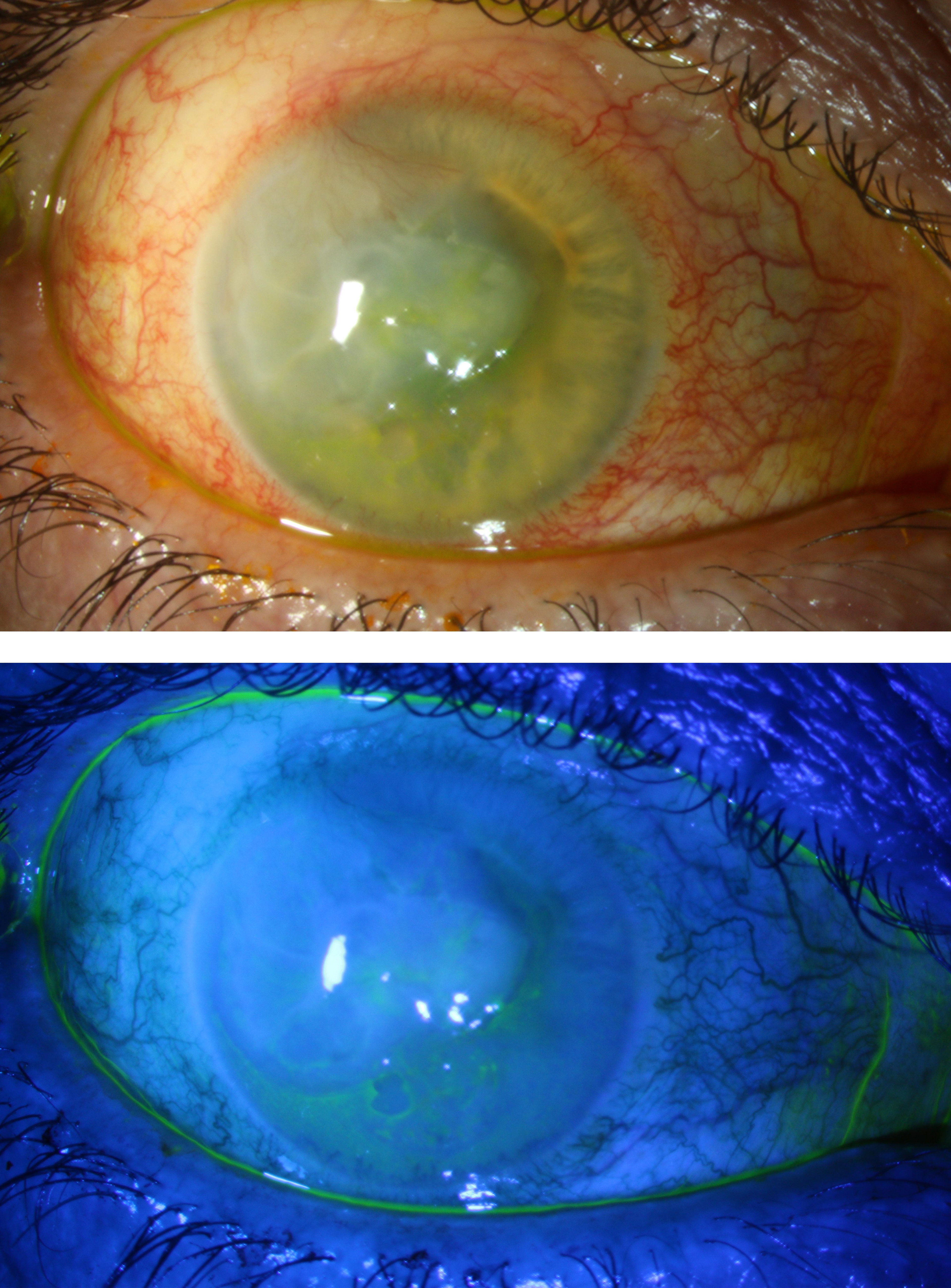 Corneal Ulcer