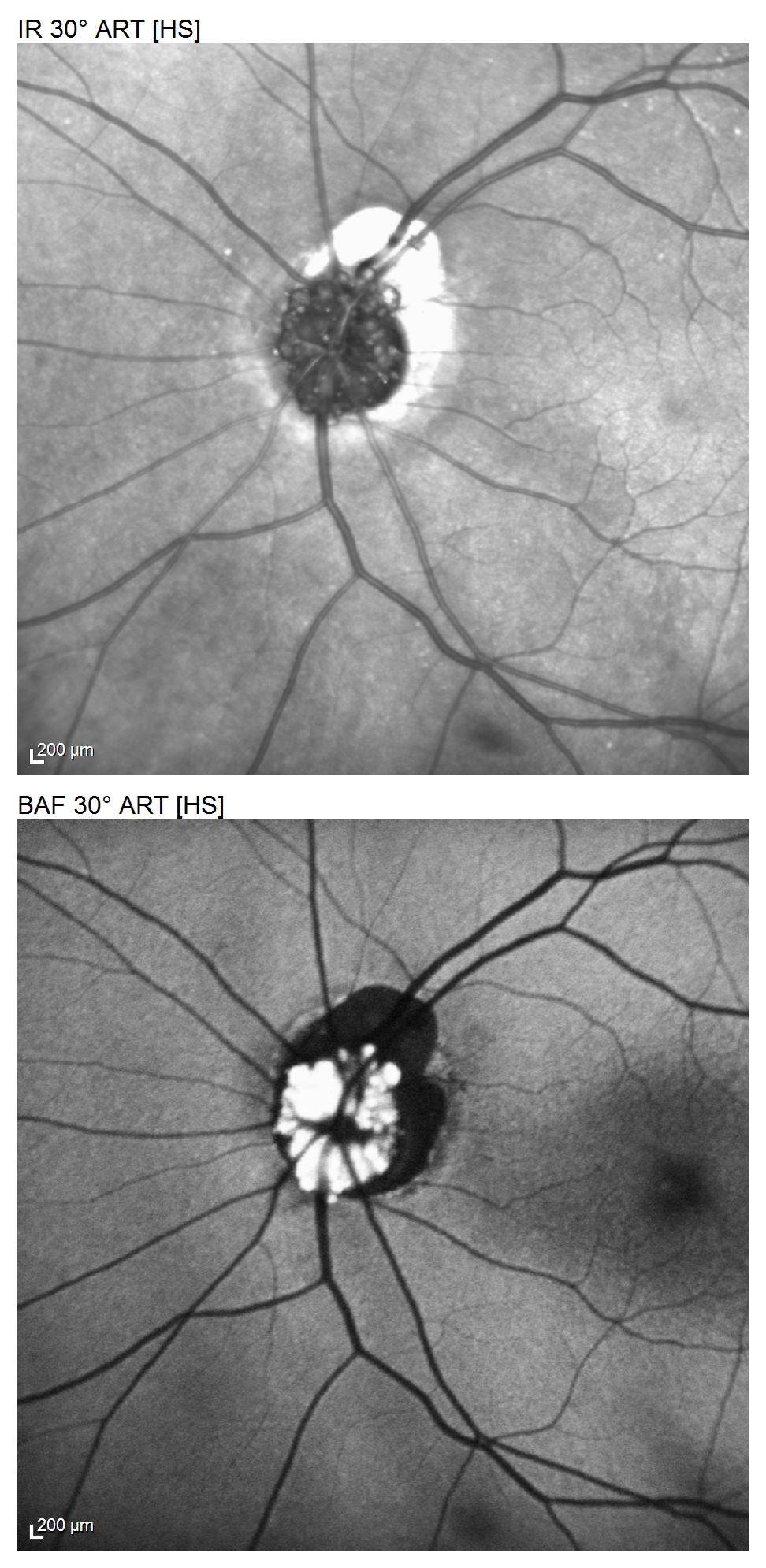 Optic Disc Drusen