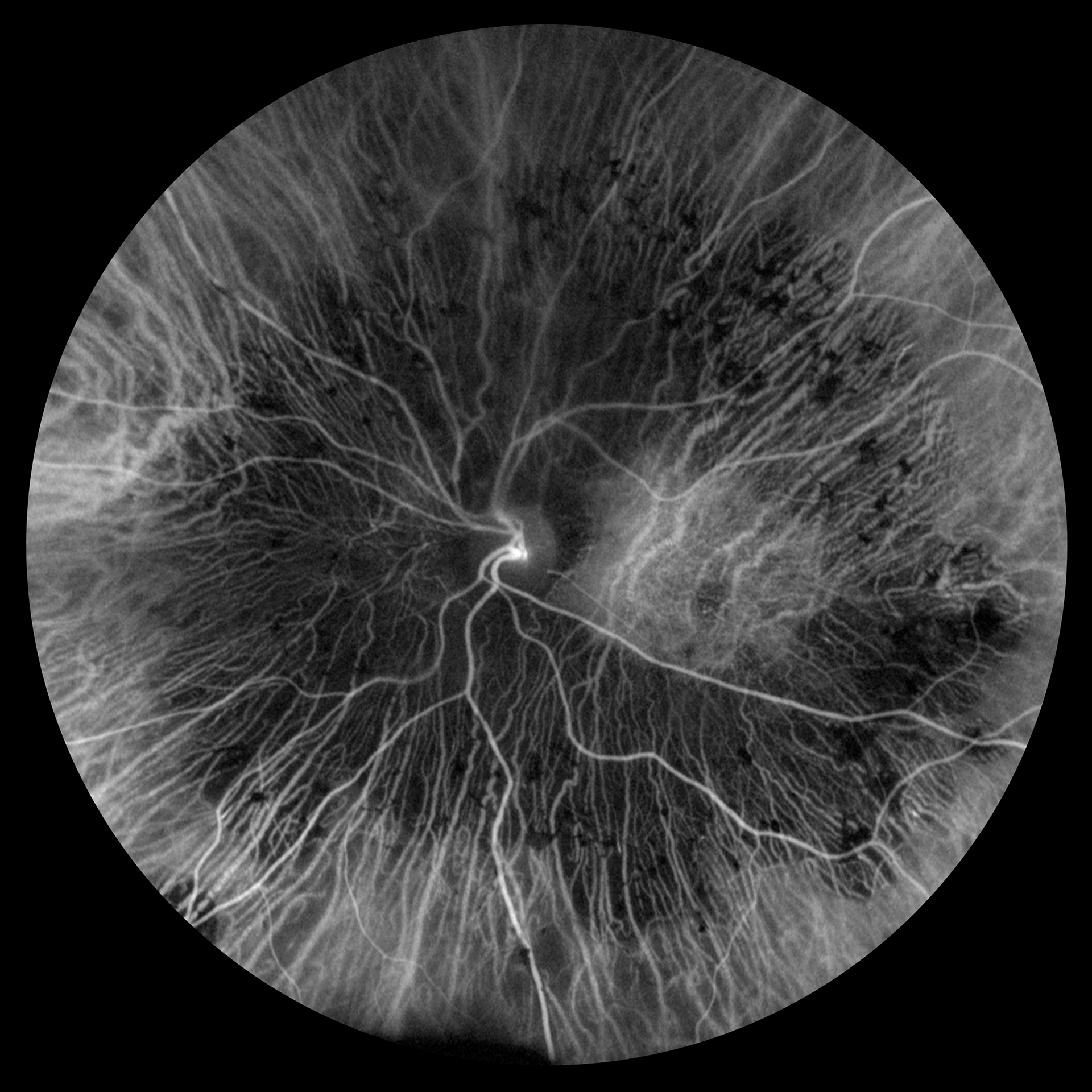 Choroidal Neovacularization