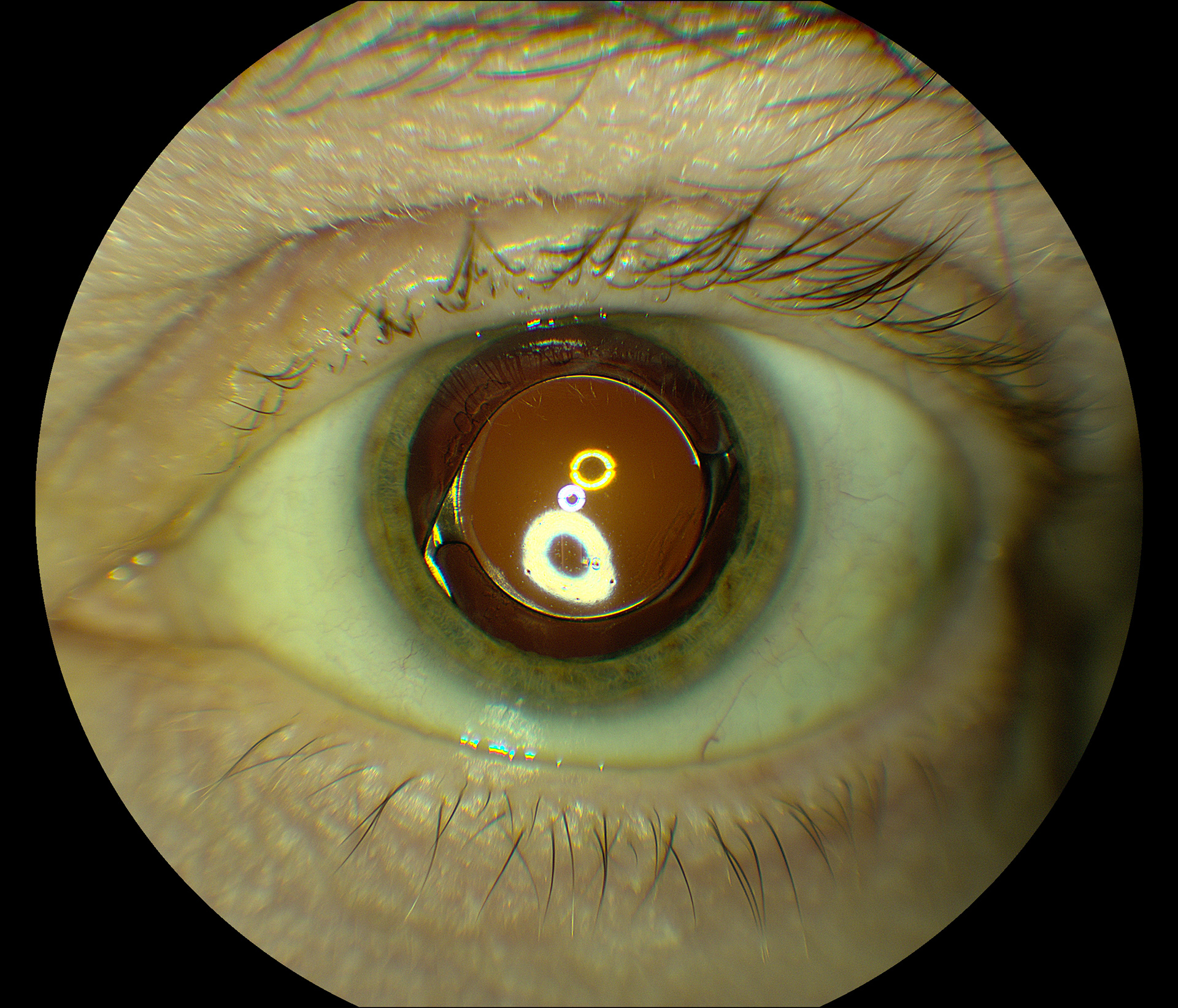 Intraocular Lens (IOL) of the Left Eye