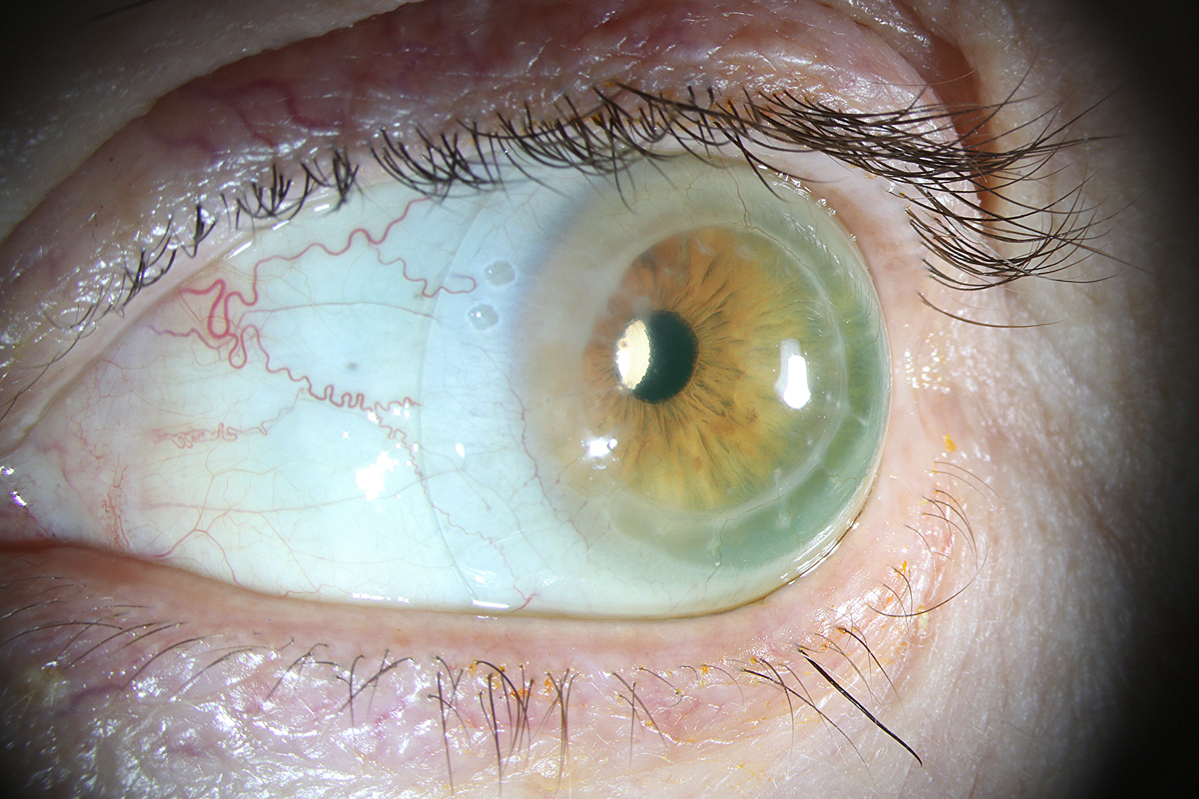 Scleral Contact Fitting
