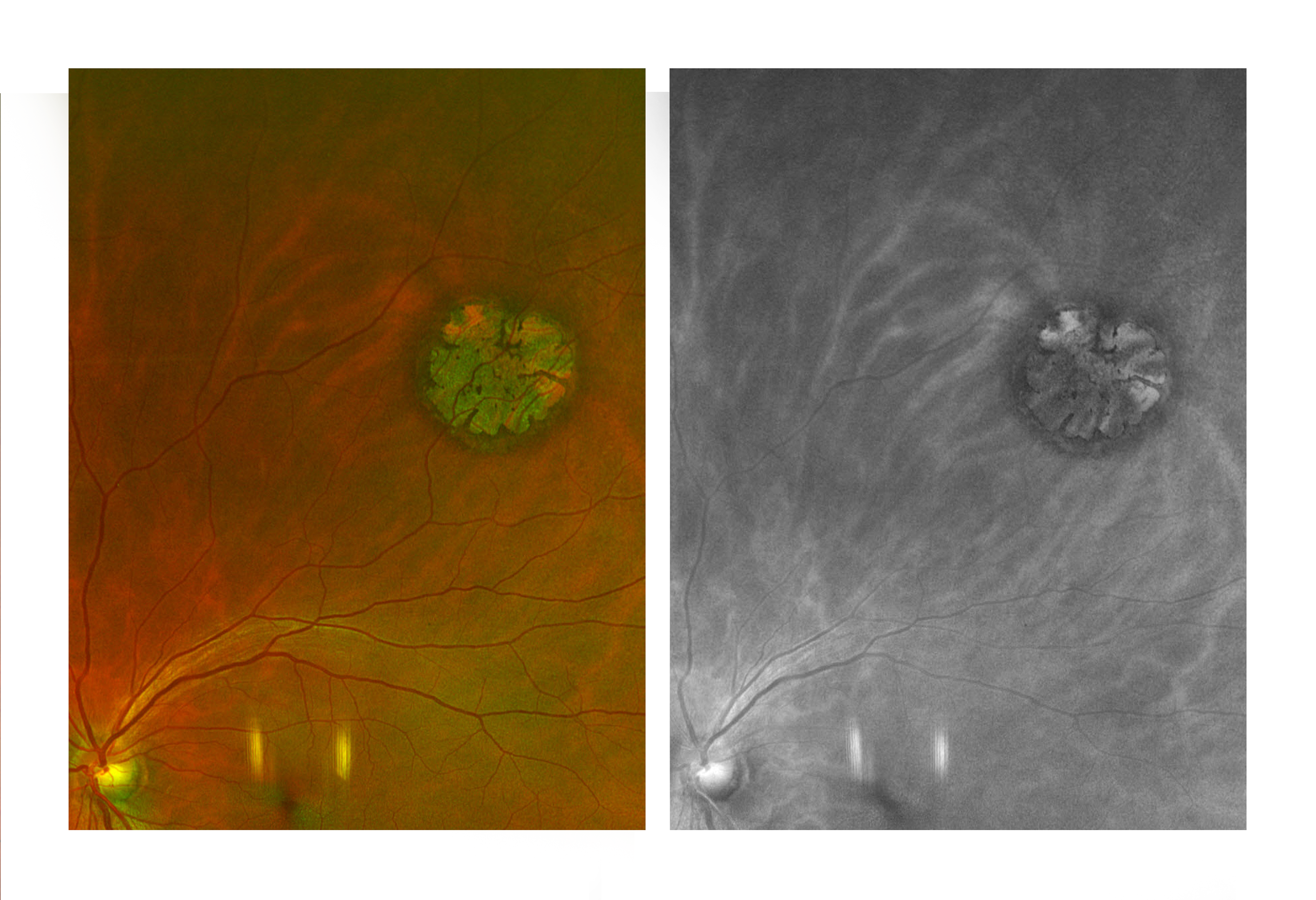 Congenital Hypertrophy Of Retinal Pigment Epithelium (CHRPE)Lesion
