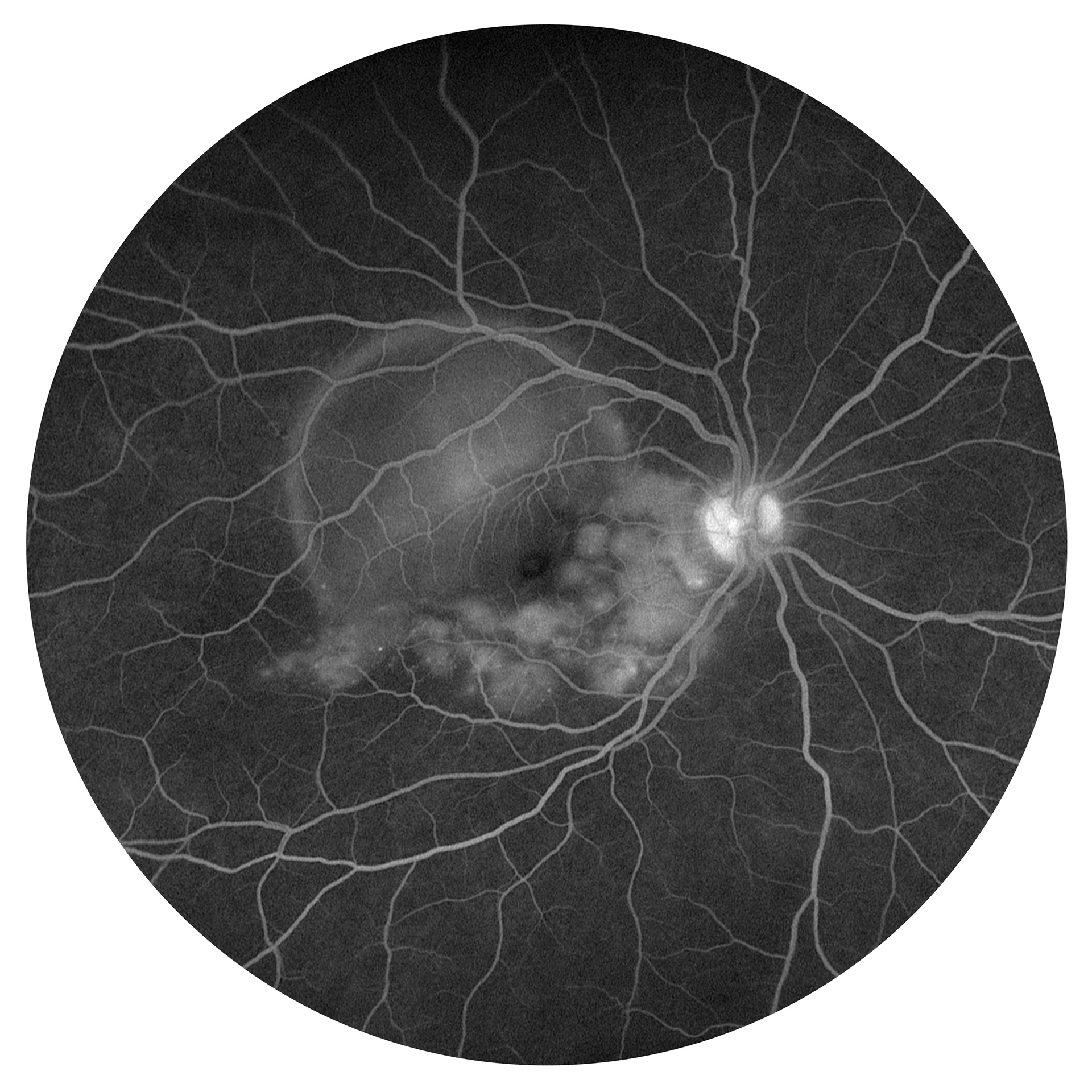 Vogt-Koyanagi-Harada Disease