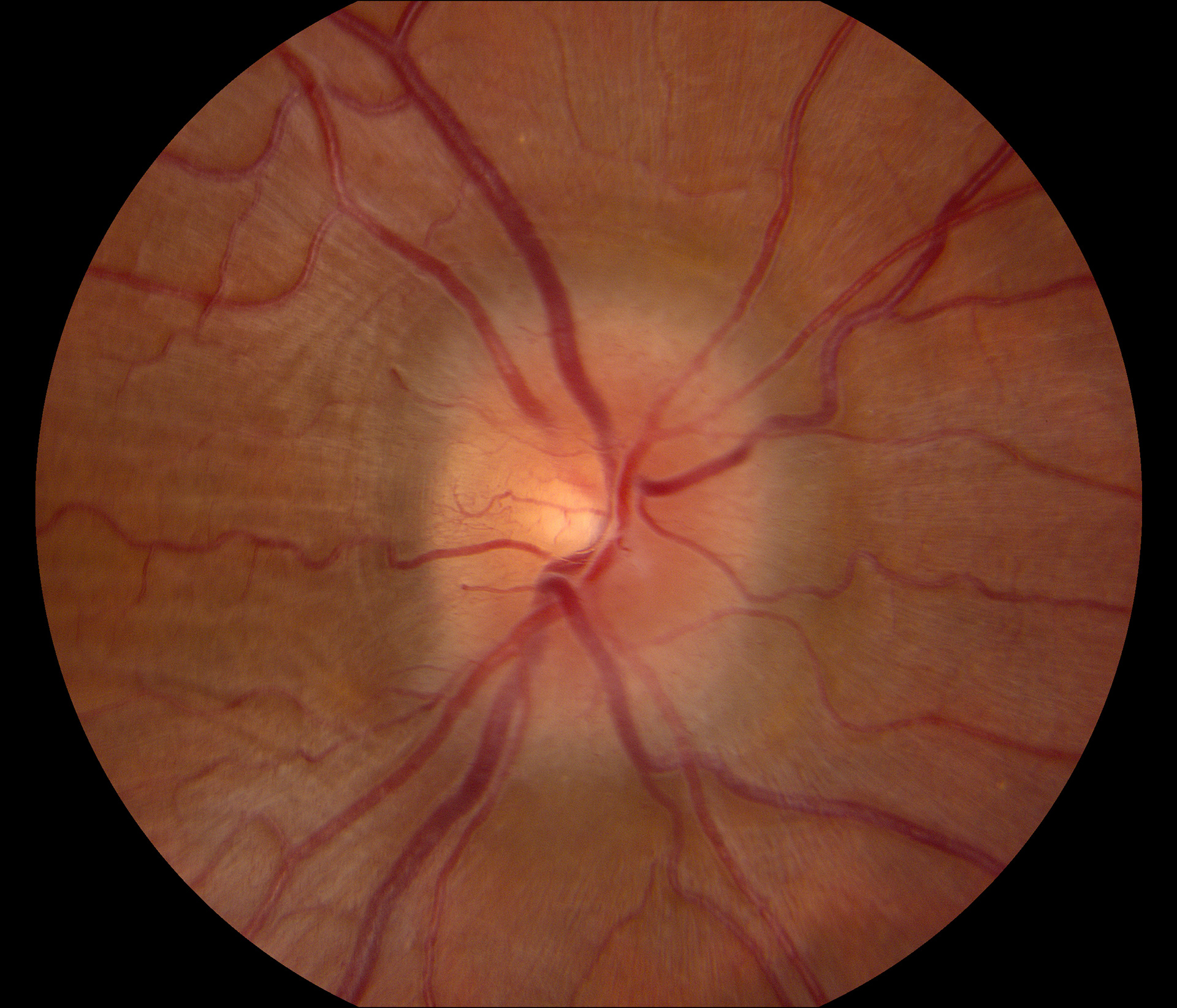 Intracranial Hypertension