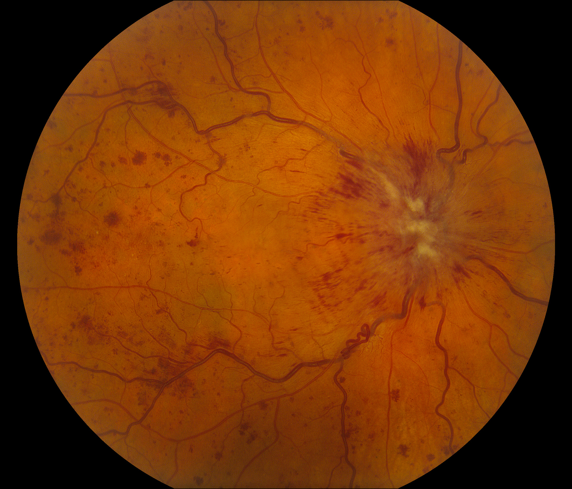Ocular Ischemic Syndrome