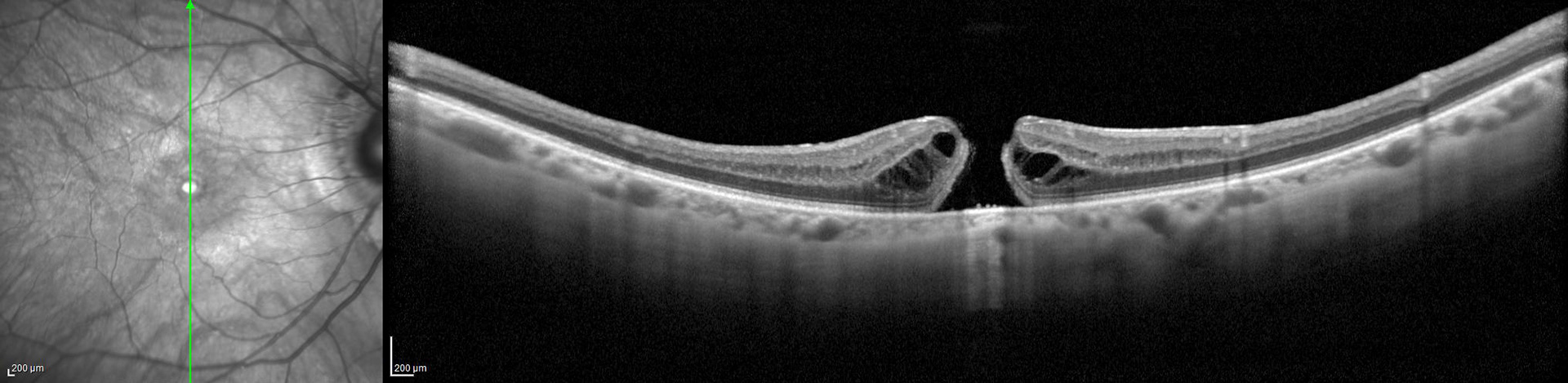Mención de honor: Agujero Laminar en la categoría Tomografía de Coherencia Óptica