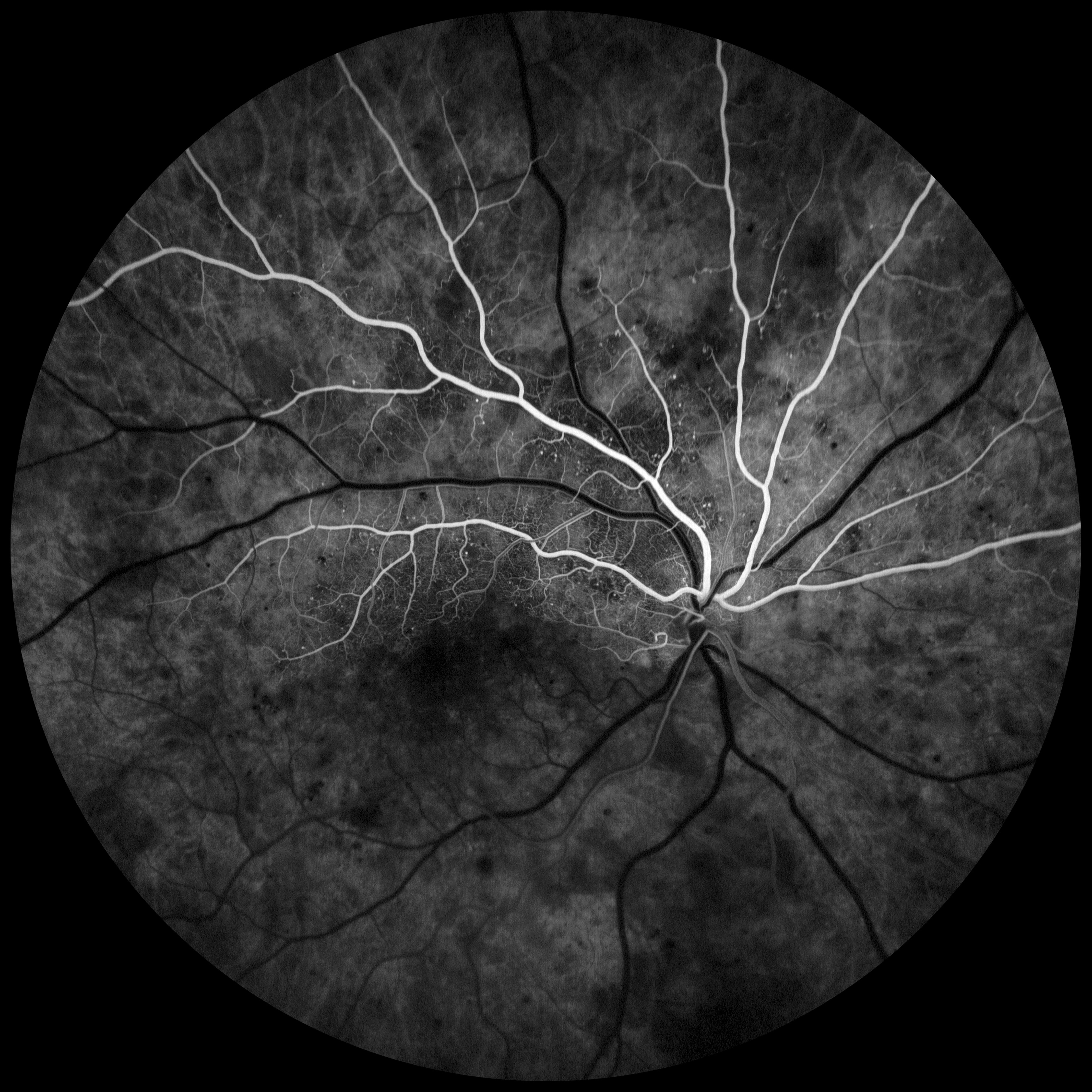 Primer Lugar:Edema Macular Diabético con Retinopatía Diabética No-Proliferativa en la categoría de Angiografía con Fluoresceína