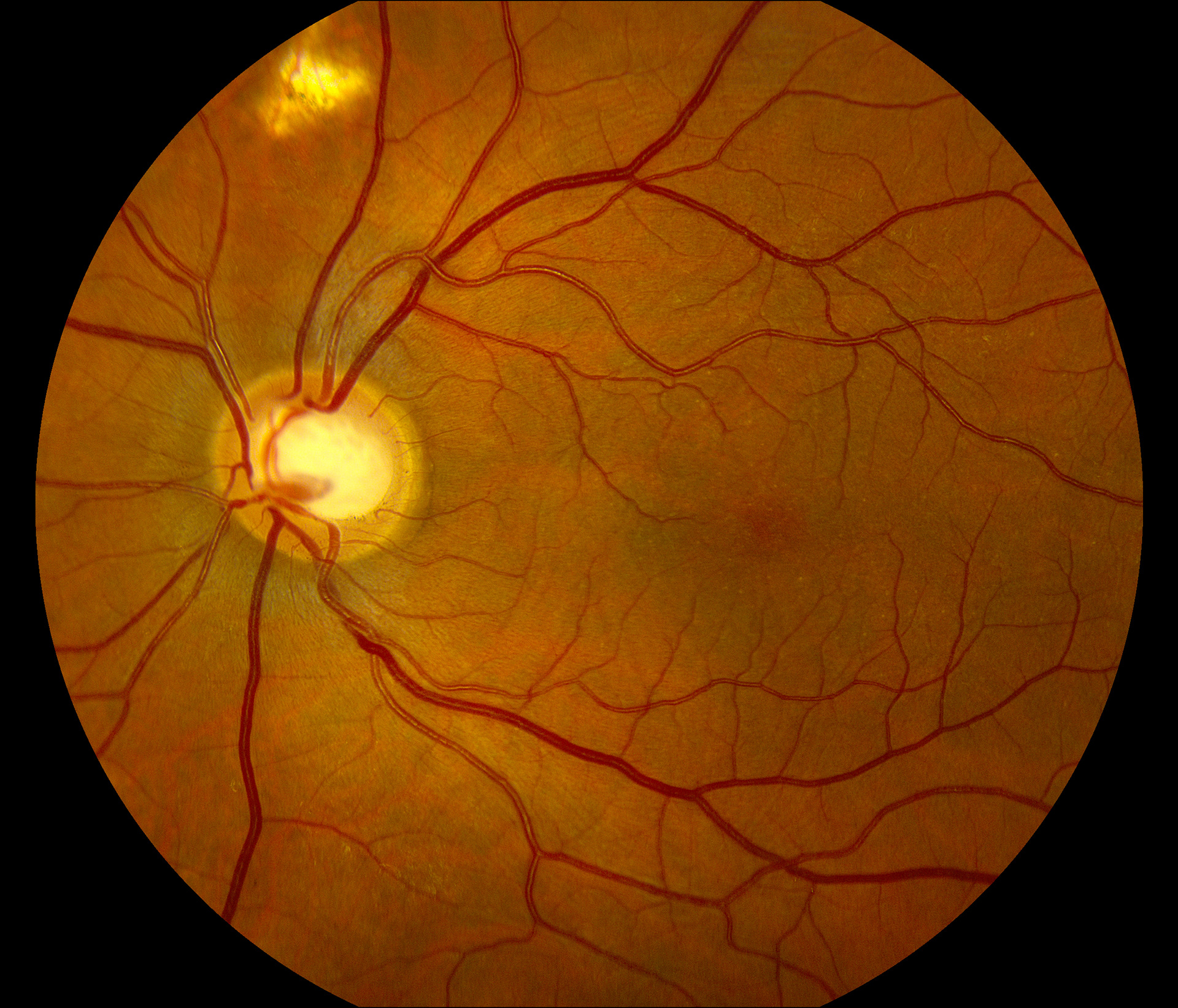 Optic Nerve Cupping