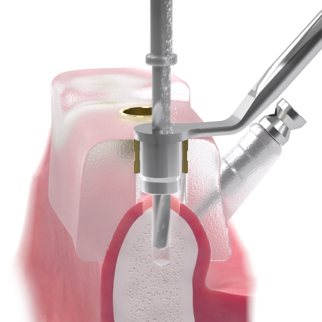 歯のインプラント手術の手順を３DCGにて再現