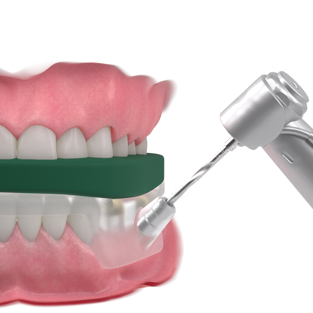 歯のインプラントガイドシステムプロモーションビデオ３DCG動画からの画像