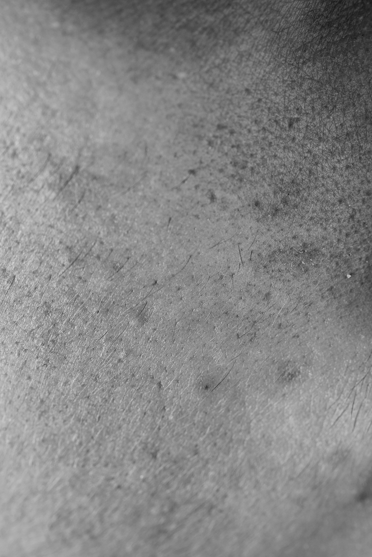 "Mon acné me gène, il me laisse des traces qui dégradent ma peau."
