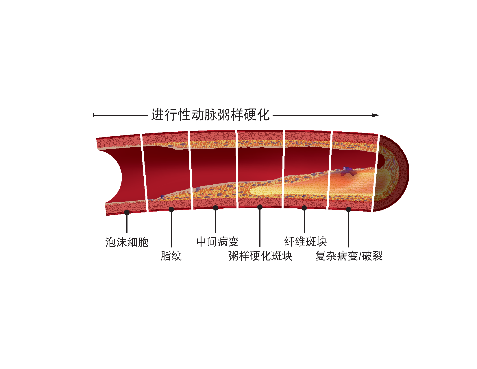 Artery plaque